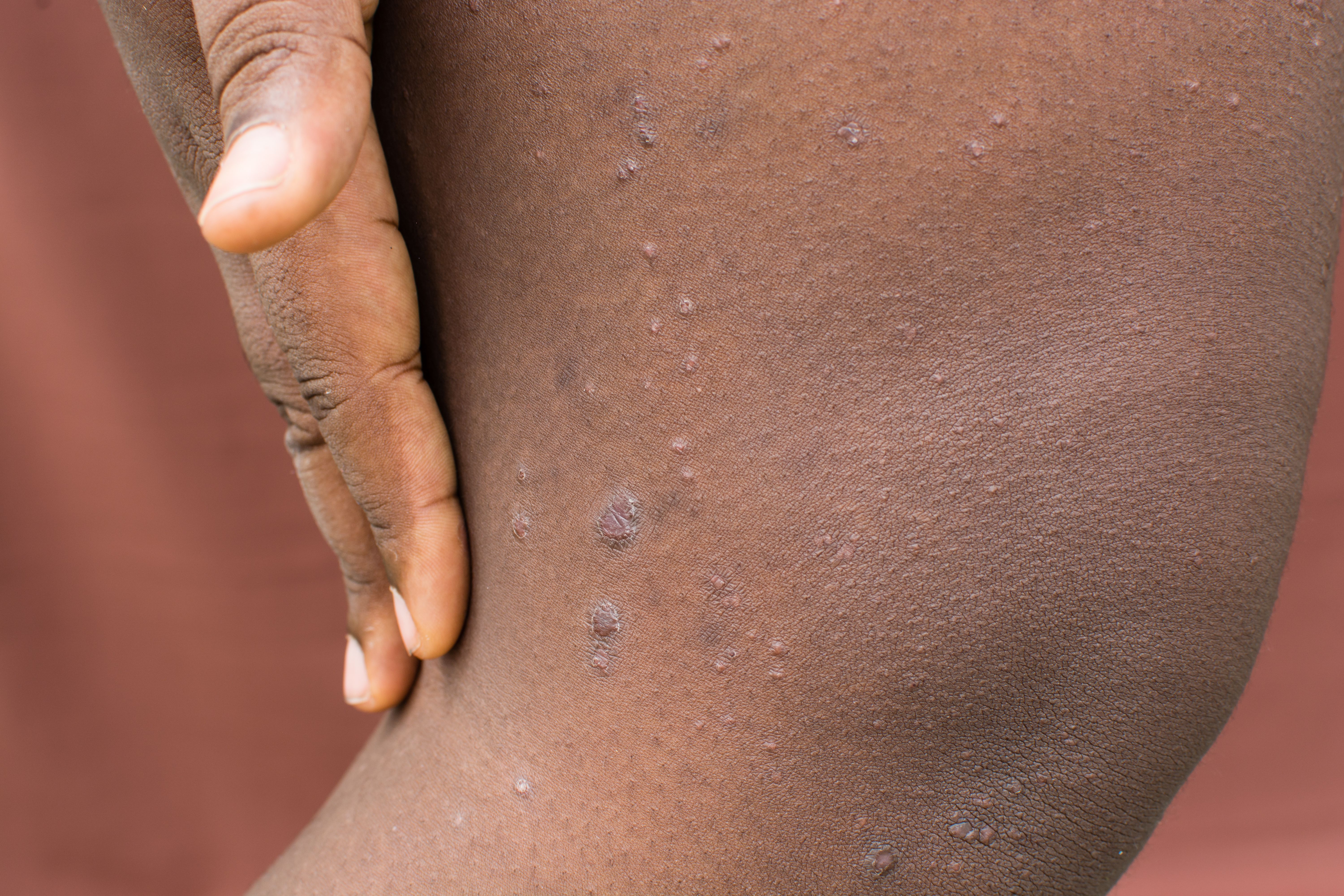 Prurigo Nodularis. | Image Credit:  this_baker -  stock.adobe.com