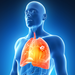 Lobectomy Outperforms Stereotactic Body Radiation Therapy In Early-Stage Lung Cancer