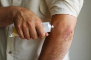 Dermatologic diseases can often lead to notable psychological distress. These findings add to the overall understanding of patient concerns over treatment. | Image credit: Olga - stock.adobe.com
