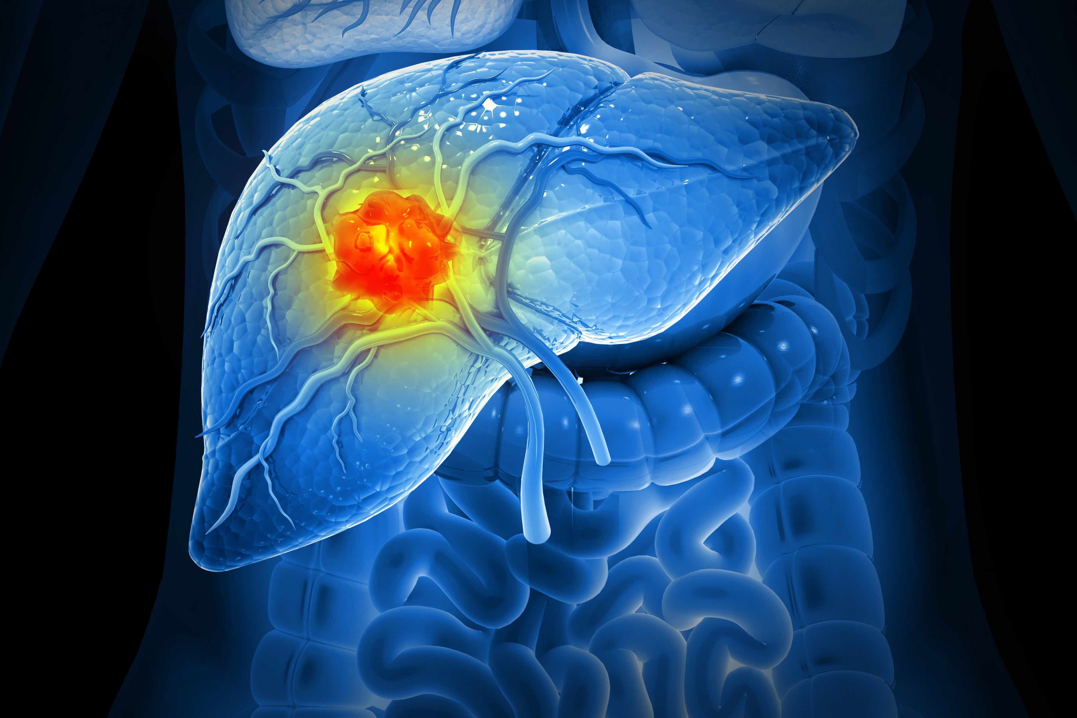Ｔｈｅ　ＬＩＶＥＲ　ＣＡＮＣＥＲ　ＪＯＵＲＮＡＬ ７-２/メディカルレビュ-社/「Ｔｈｅ　Ｌｉｖｅｒ　Ｃａｎｃｅｒ　Ｊｏ（単行本） Liver Cancer