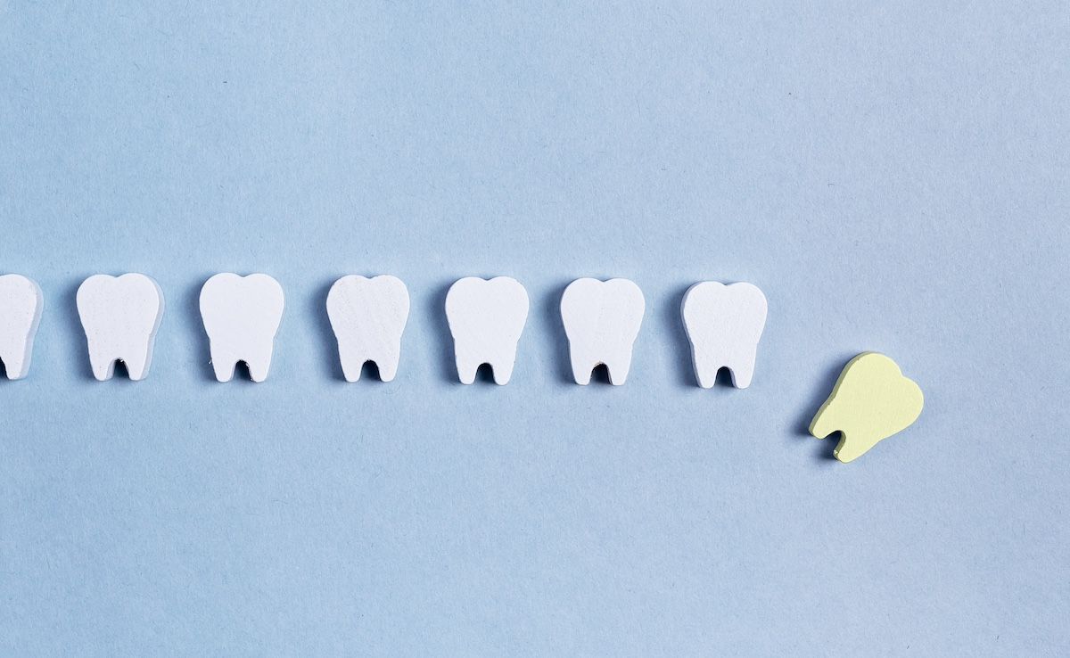 Tooth loss | Image Credit: © valiantsin-stock.adobe.com