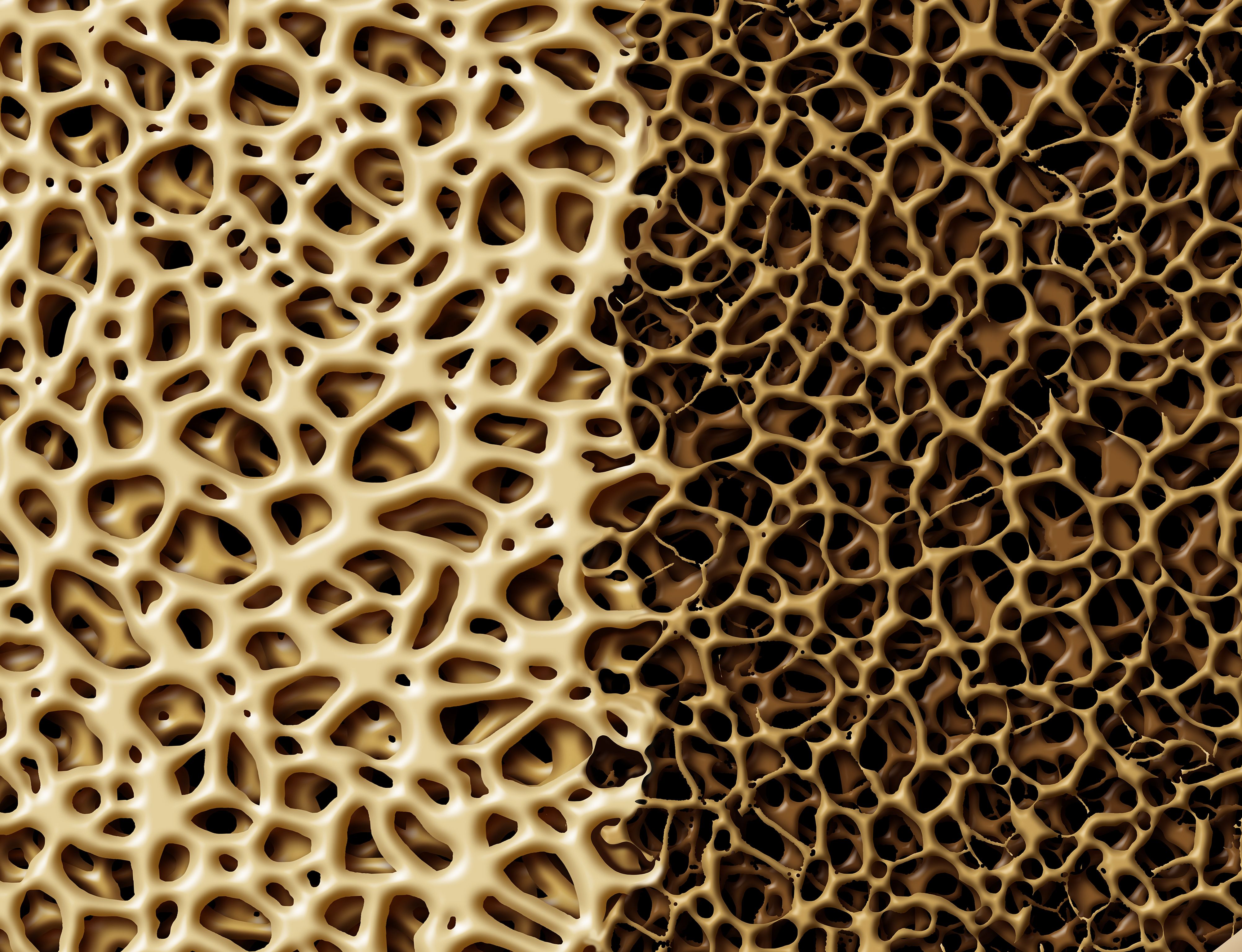 Bone Deterioration | freshidea - stock.adobe.com