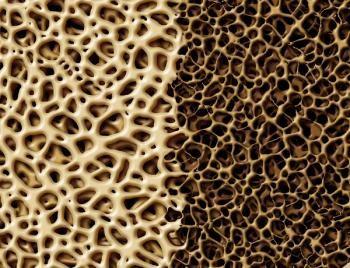 Bone Deterioration | freshidea - stock.adobe.com