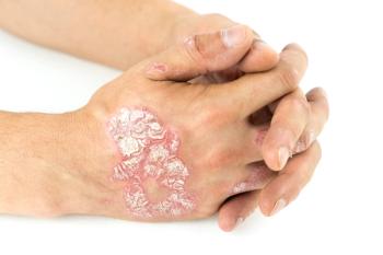 Psoriasis vulgaris on the male hands with plaque, rash and patches, isolated on white background.| Ban - stock.adobe.com