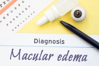 Macular edema | Image credit: shidlovski - stock.adobe.com