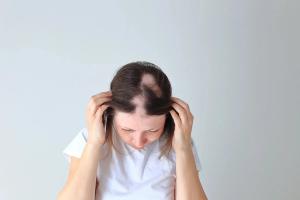 Top of woman's scalp showing hair loss | Image credit: Nadya Kolobova - stock.adobe.com