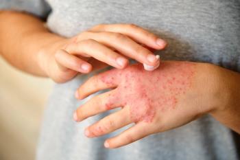 Ruxolitinib cream. | Image Credit: Ladanifer -  stock.adobe.com