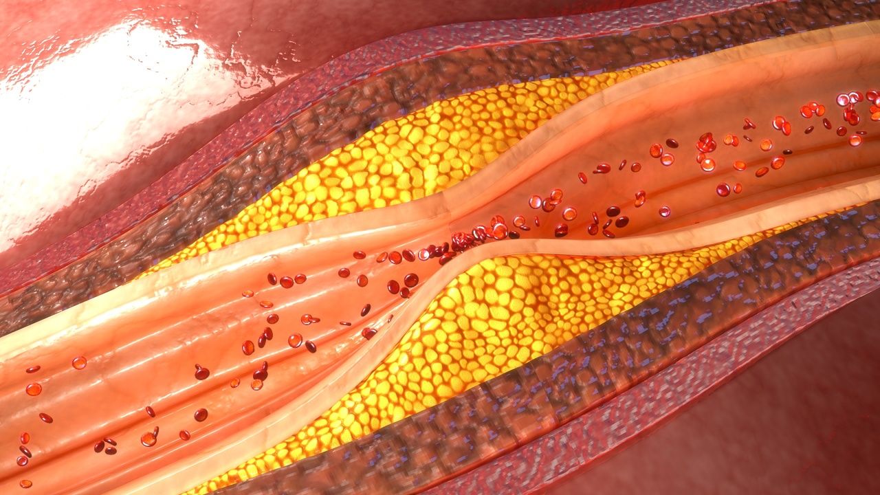 Biologic Therapy for Psoriasis Reduced Coronary Inflammation, Study Says