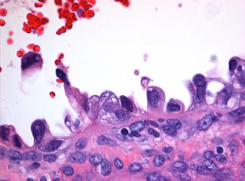 Clear cell carcinoma | Image credit: Sunnybrook Health Sciences Center
