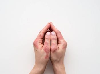 Psoriasis. | Image Credit: IIIRusya - stock.adobe.com