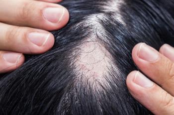 Alopecia areata. | Image Credit: cattyphoto  - stock.adobe.com 