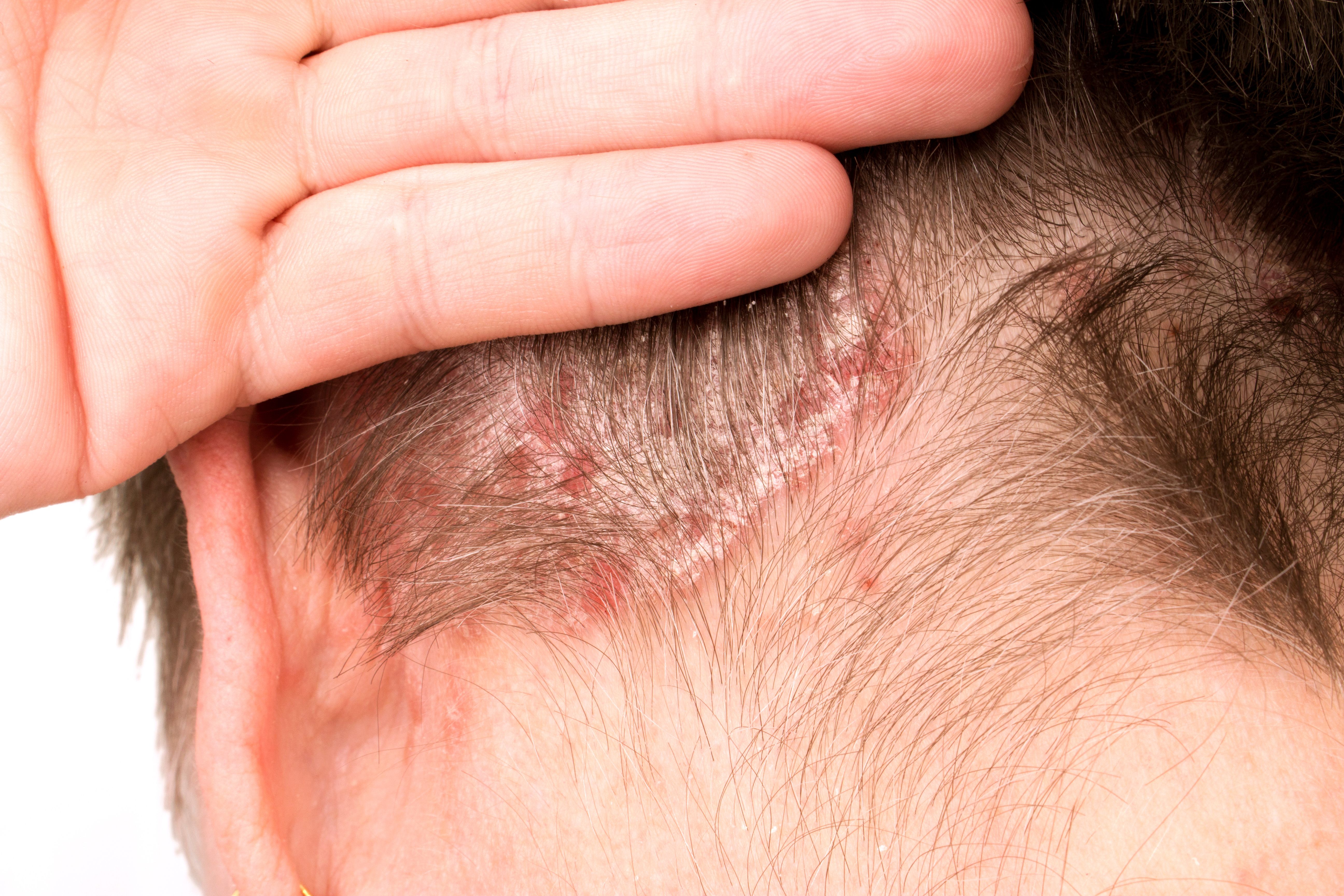 Plaque psoriasis | Image credit: Milan Lipowski - stock.adobe.com