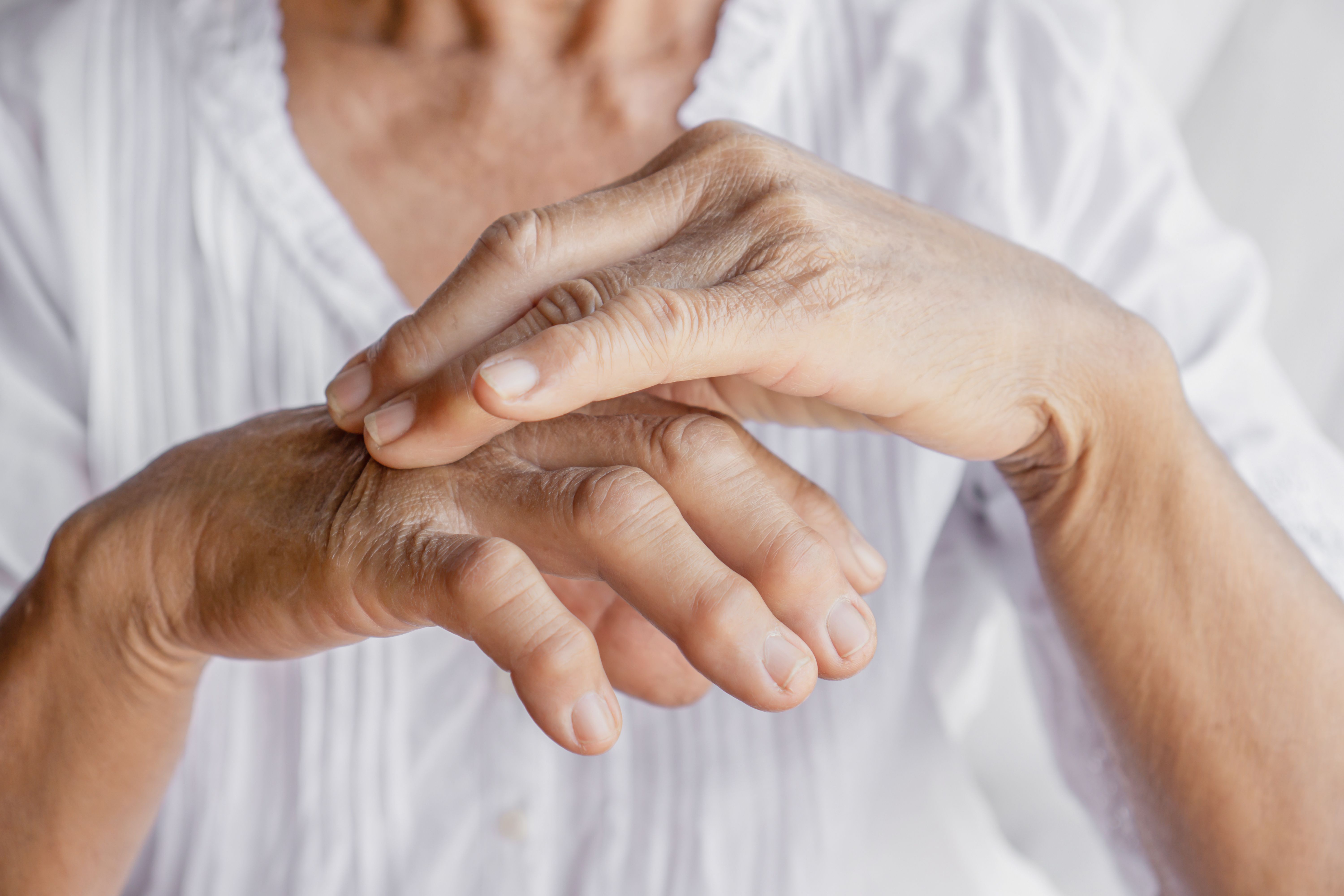 Hand pain gout arthritis | Image credit: doucefleur - stock.adobe.com