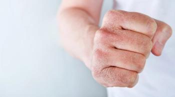 cracked hand fist | Image credit: kasia2003 - stock.adobe.com