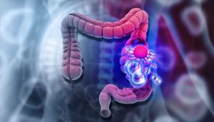 colon cancer | Image credit: Rasi - stock.adobe.com
