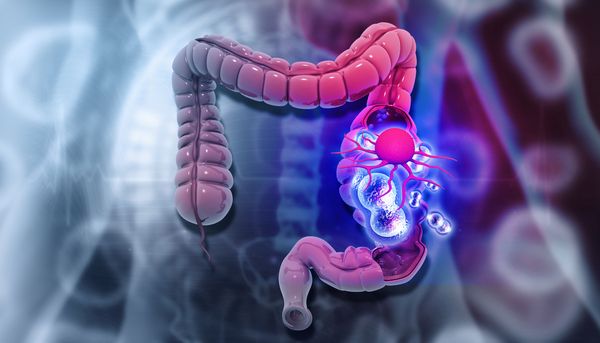 colon cancer | Image credit: Rasi - stock.adobe.com