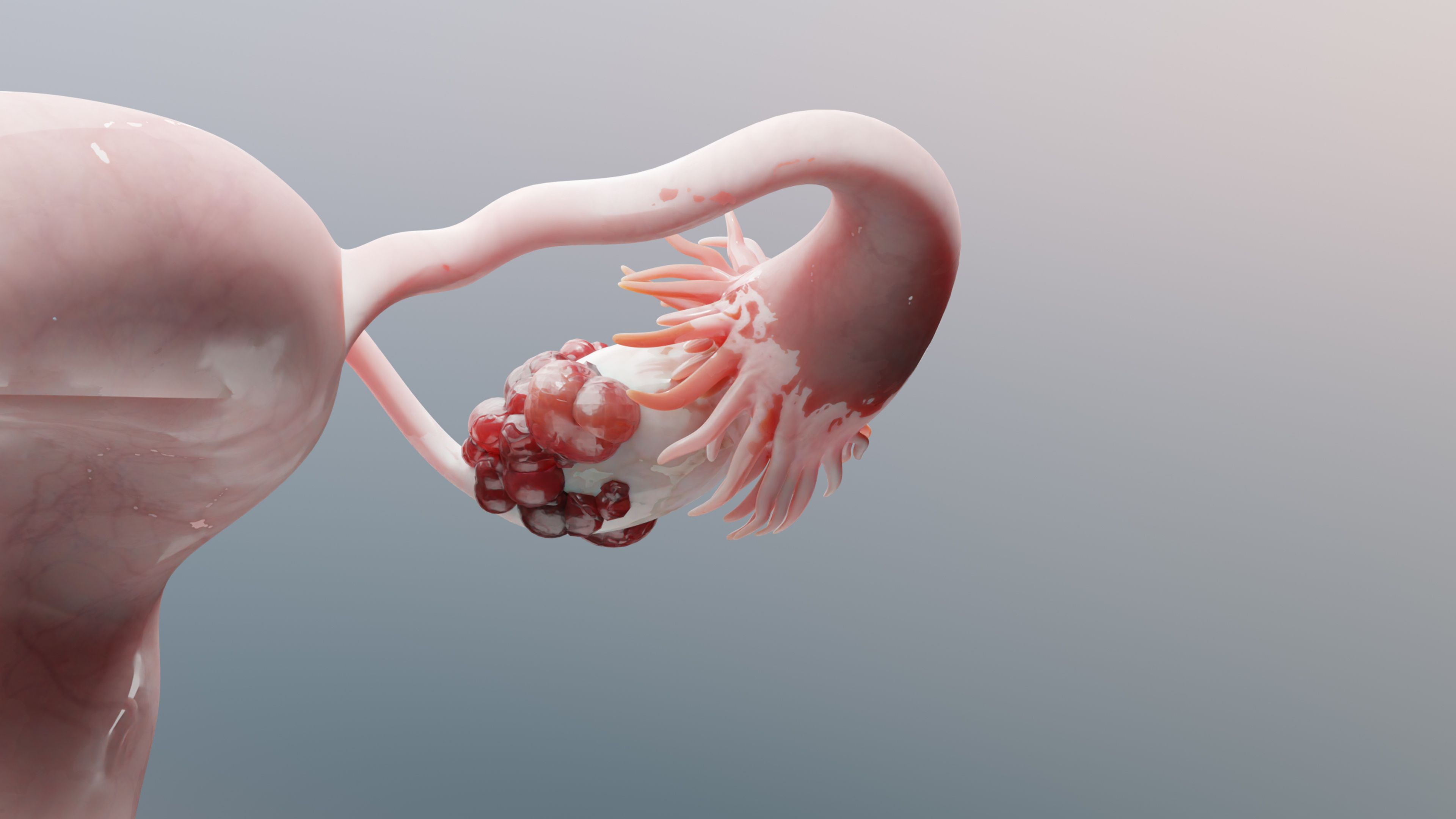 Ovarian cancer animation | Image Credit: MohammedElAmine - stock.adobe.com