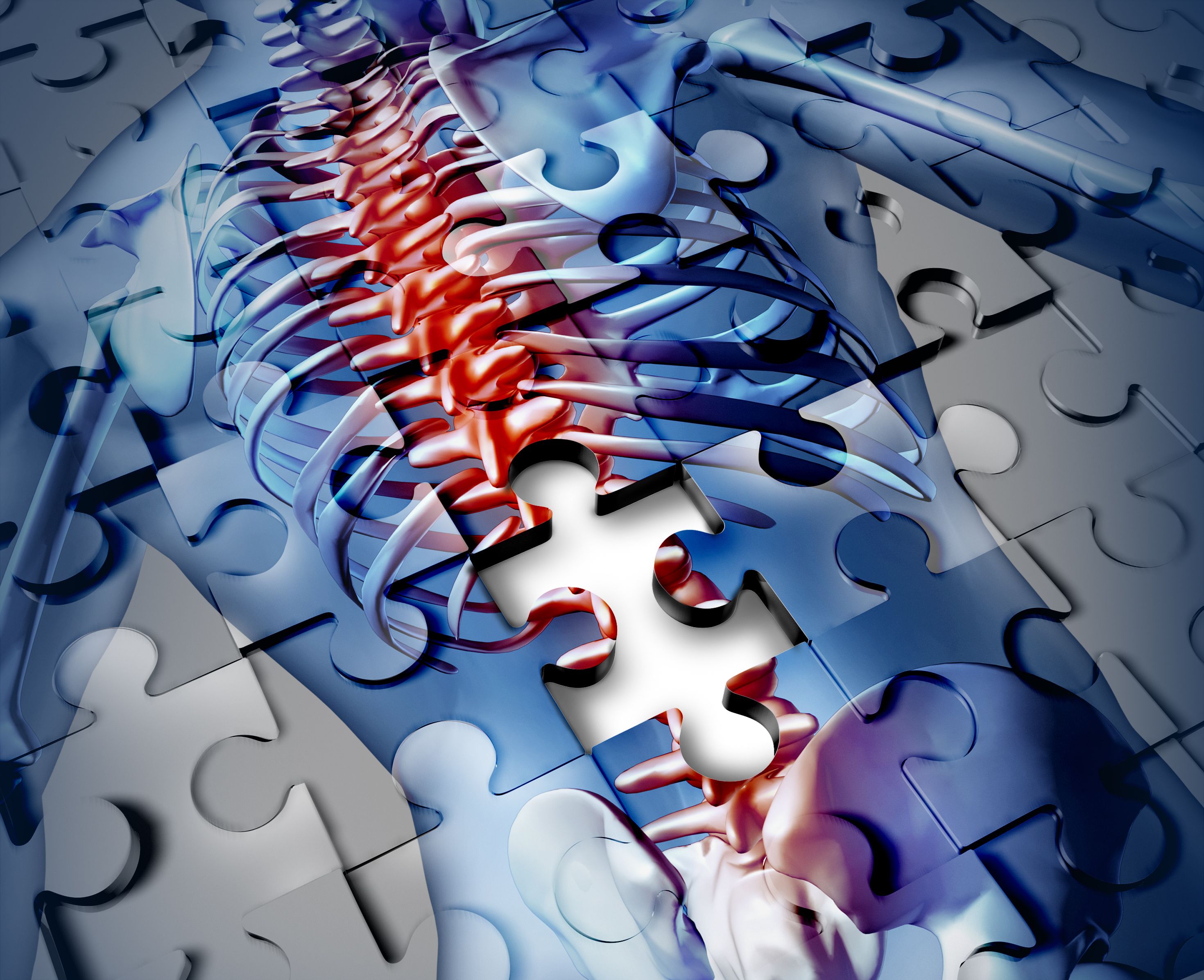 Case Report Shows Neuropathological, Molecular Findings of SMA Type 3 With Superficial Siderosis