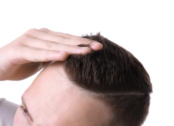 Man with hair loss measuring regrowth | Image Credit: Pixel-Shot - stock.adobe.com