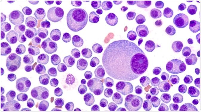 Multiple myeloma