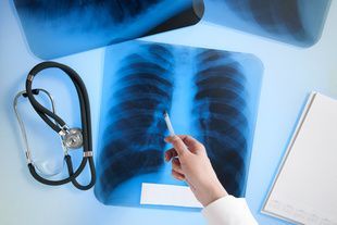 graphic of lung x ray