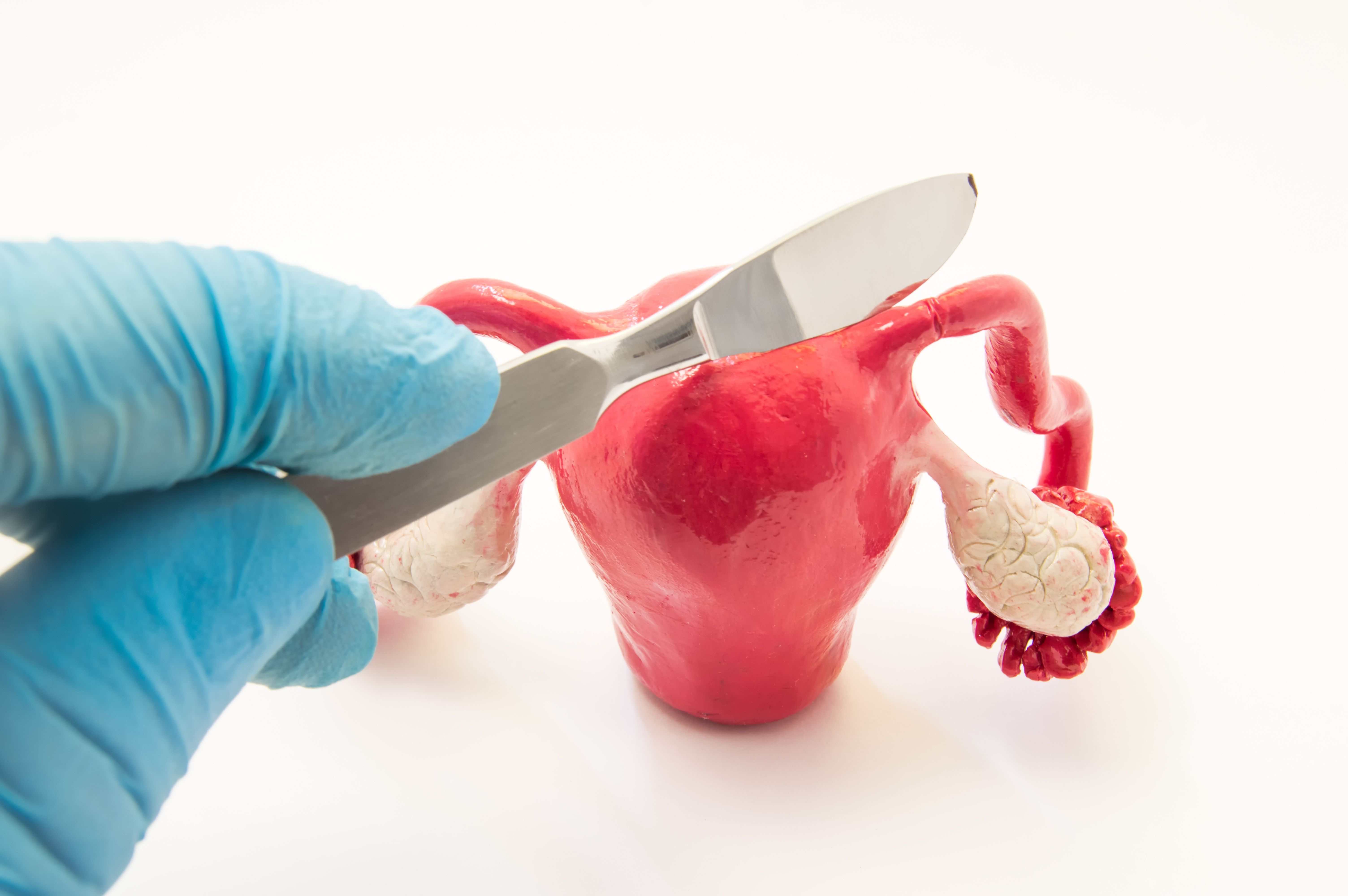 Salpingectomy demonstration | Image Credit: shidlovski - stock.adobe.com