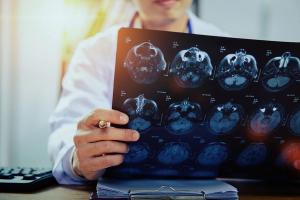 MRI for patient with MS assessed by doctor | Image credit: pixfly - stock.adobe.com