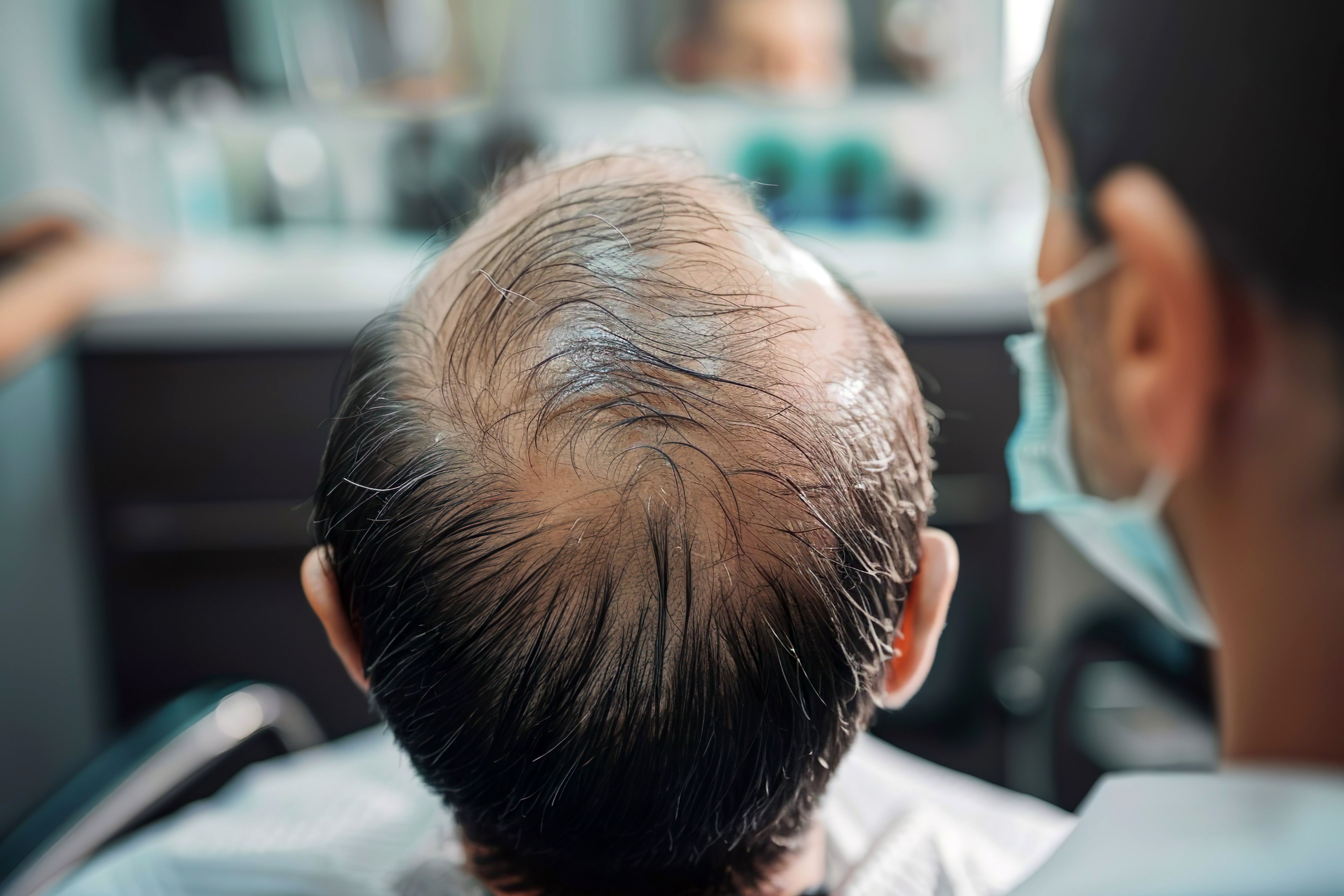 Male pattern baldness | Image Credit: Oksana - stock.adobe.com