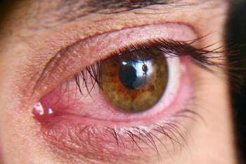 Dry eye | Image credit: Kryuchka Yaroslav - stock.adobe.com