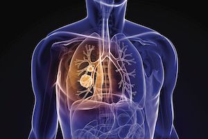 Pembrolizumab Improved OS, PFS as First-Line Treatment in NSCLC