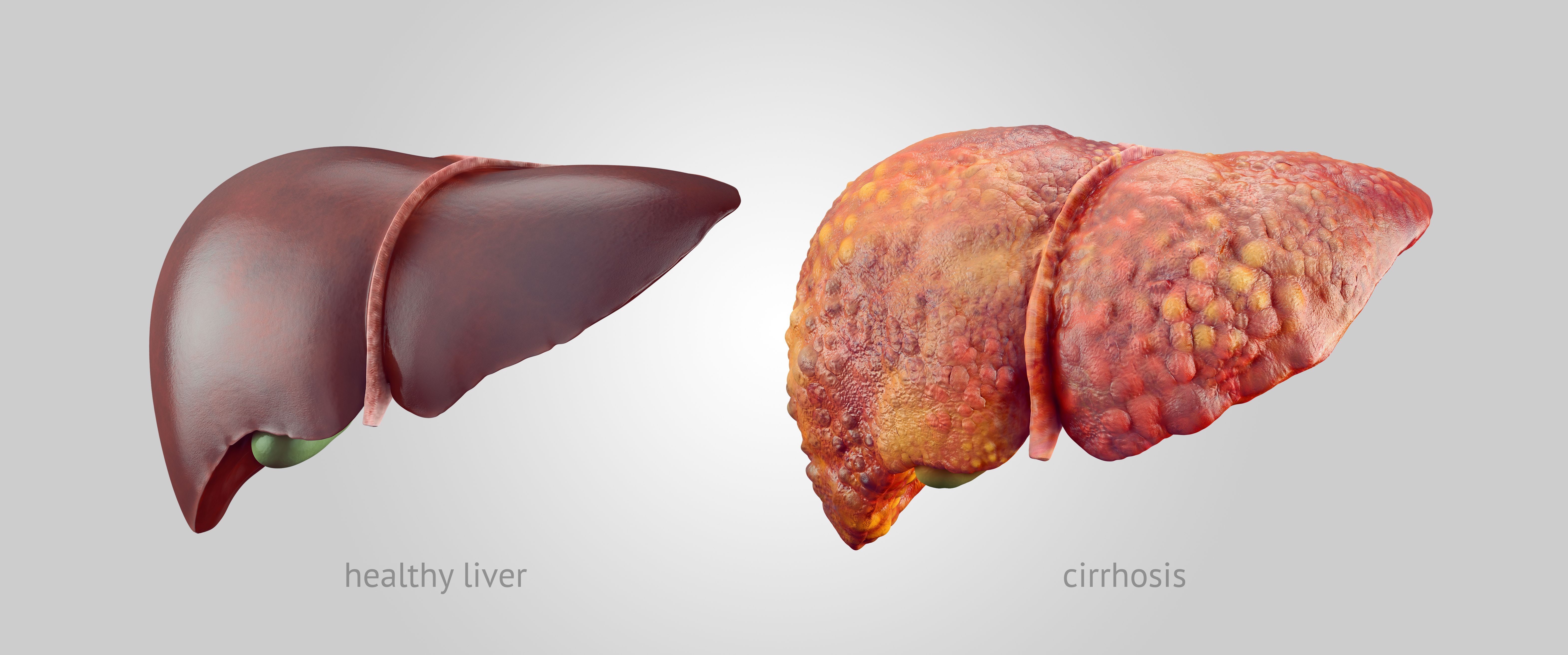 cirrhosis | image credit: eranicle - stock.adobe.com