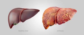 cirrhosis | image credit: eranicle - stock.adobe.com