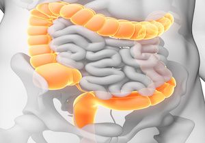 Sarcopenia and Inflammation Associated With Increased Risk of Death in Patients with Colorectal Cancer