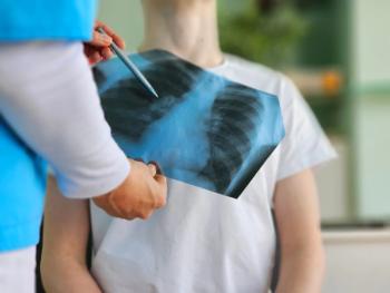 Chest x-ray | Image credit: Nadzeya – stock.adobe.com