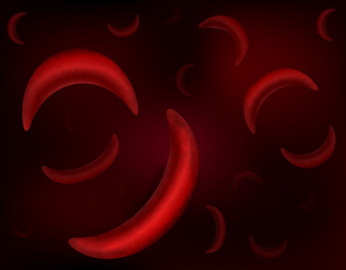 sickle cell