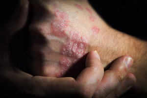 Psoriasis | Image credit:  SergeVo - stock.adobe.com