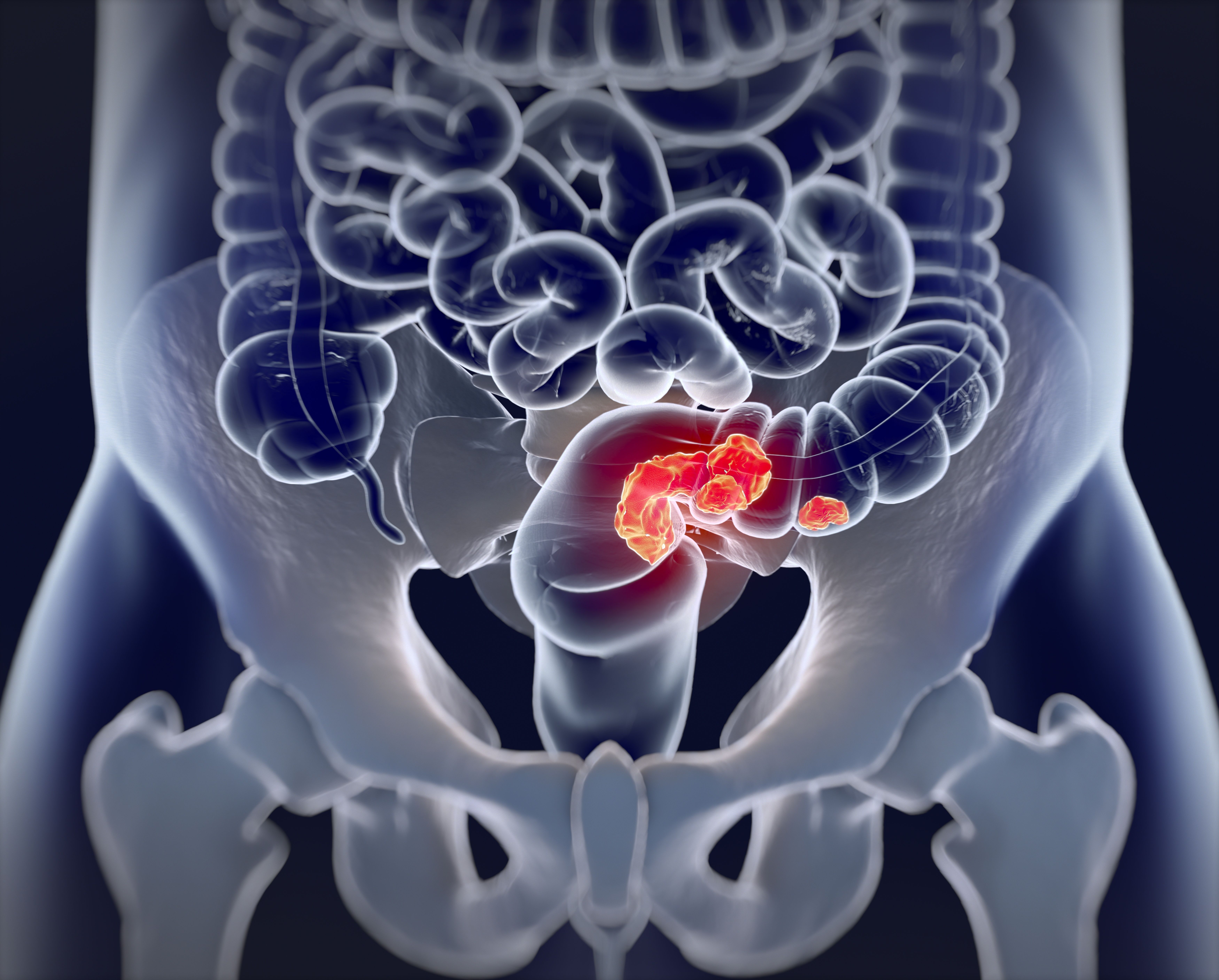 Rectal cancer | Image credit: Anatomy Insider - stock.adobe.com