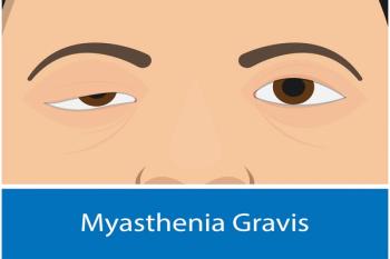 Ocular Myasthenia Gravis | Image Credit: © Pepermpron-stock.adobe.com