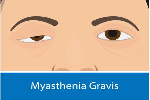 Ocular Myasthenia Gravis | Image Credit: © Pepermpron-stock.adobe.com