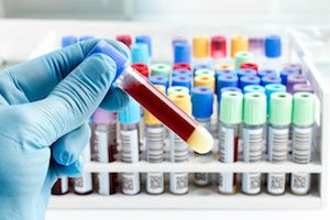 Blood Condition That Precedes Myeloma Presents Improved Chance for Early Treatment