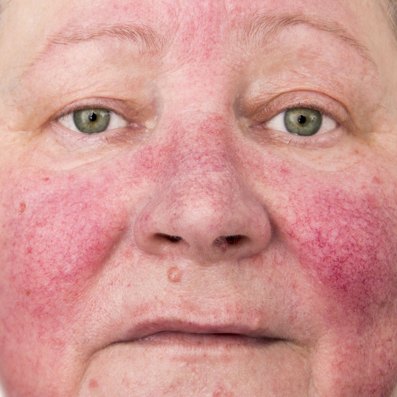 Image of patients with rosacea