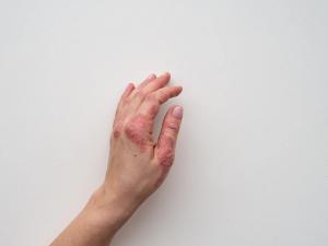 Hand with eczema on white background | Image Credit: IIIRusya - stock.adobe.com