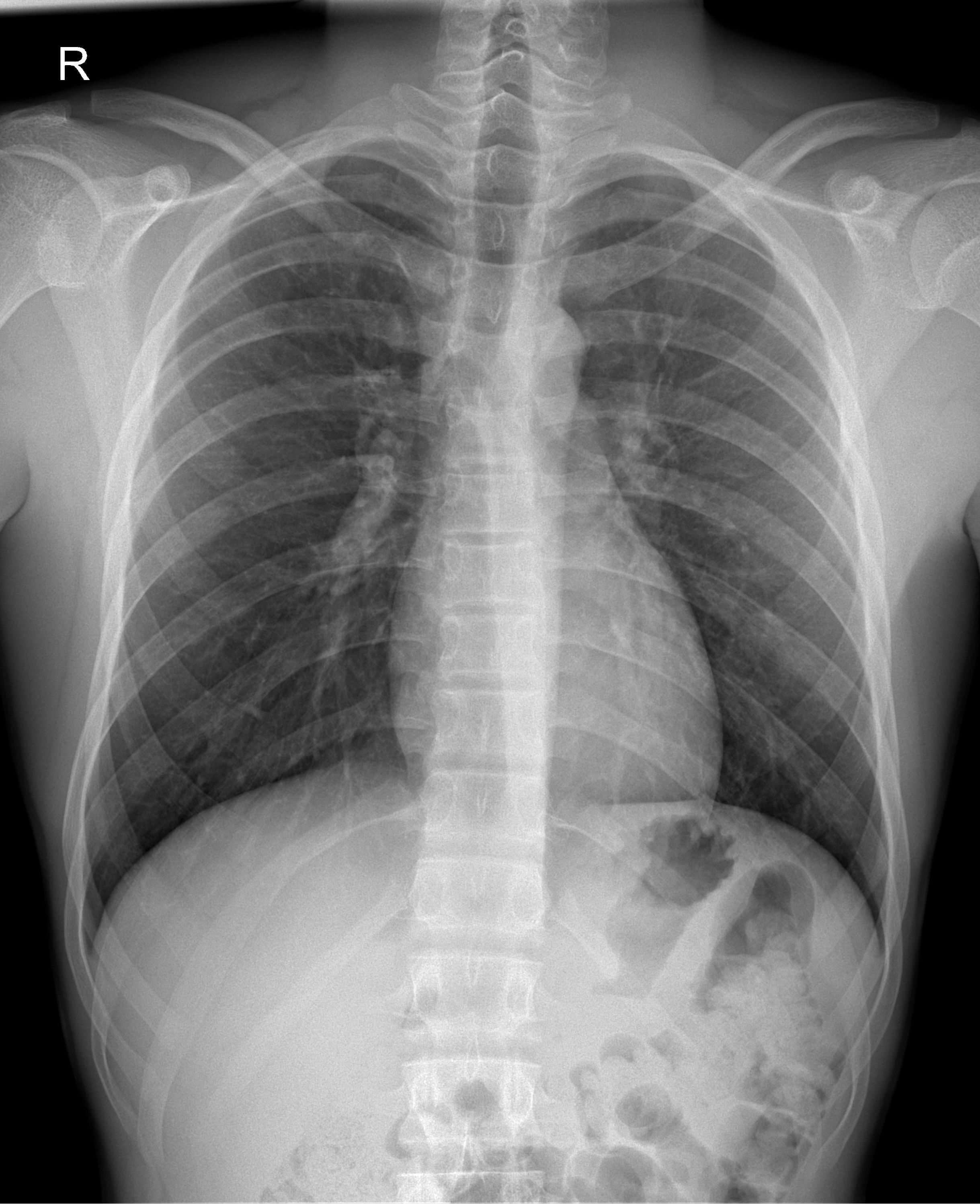 Chest X-ray for lung health assessment | image credit: Radiographys - stock.adobe.com