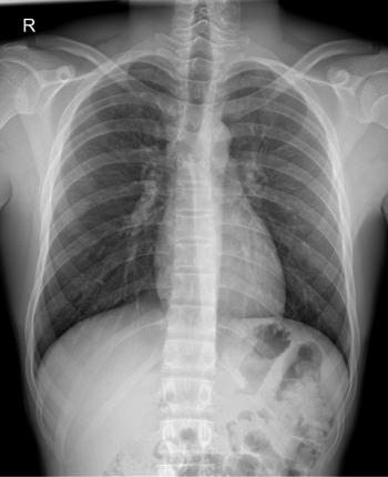 Chest X-ray for lung health assessment | image credit: Radiographys - stock.adobe.com