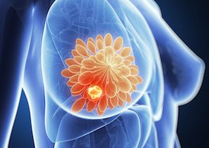 Study Tries to Pinpoint Factors Predicting Pain After Breast Cancer Surgery