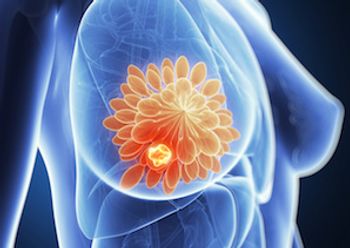 Breast cancer