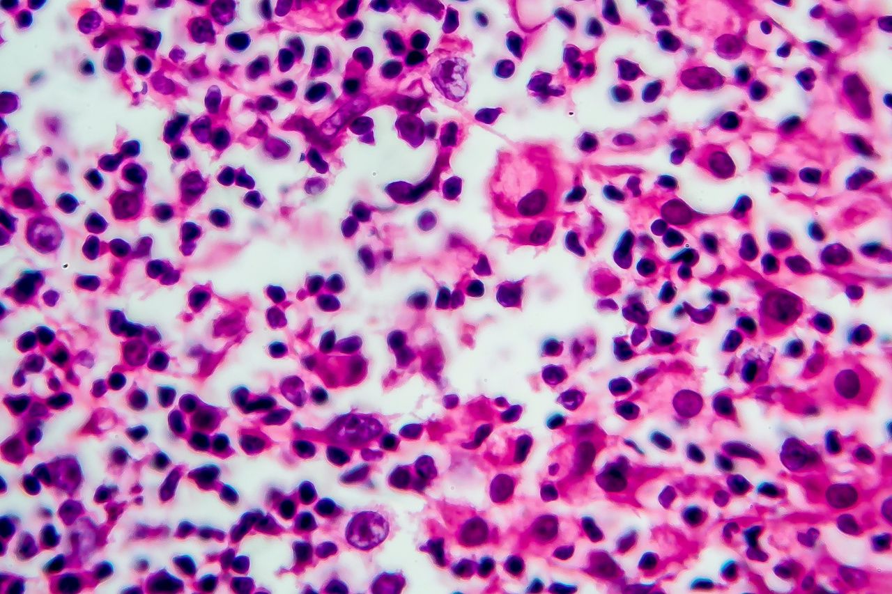 Hodgkin lymphoma | Image credit: Dr_Microbe - stock.adobe.com