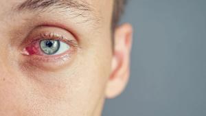 Dry eye | Image credit: lenblr - stock.adobe.com