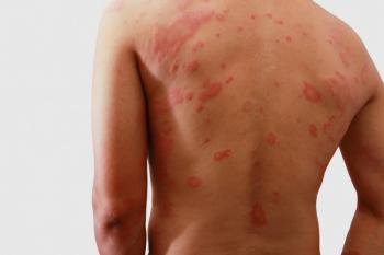 Man with hives