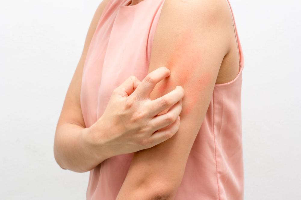 Image of atopic skin irritation.